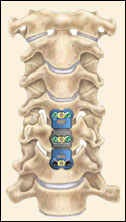 Anterior Cervical Discectomy w/ Fusion