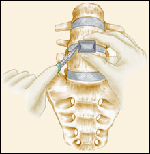 Anterior Lumbar Interbody Fusion (ALIF)