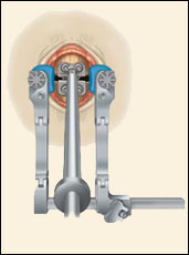 prestige cervical disc surgery