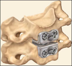 prestige cervical disc surgery