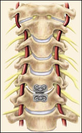 prestige cervical disc surgery