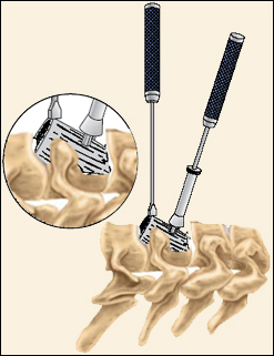 Cervical Corpectomy