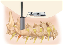 Cervical Foraminotomy