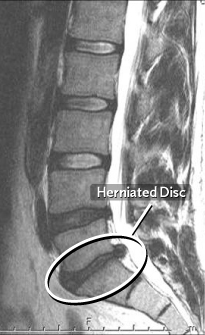 Herniated Discs