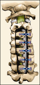 Cervical Laminoplasty