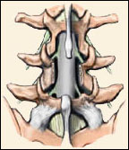 Lumbar Laminectomy