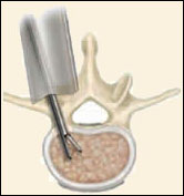 Lumbar Microdiscectomy