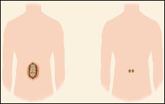 Transforaminal Lumbar Interbody Fusion (PLIF)