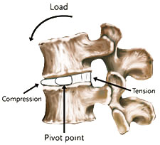 Degenerative Disc Disease