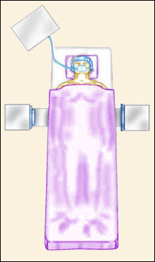 Anterior Lumbar Interbody Fusion (ALIF)