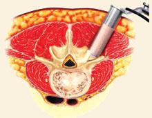 Transforaminal Lumbar Interbody Fusion (PLIF)