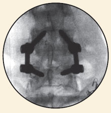 Transforaminal Lumbar Interbody Fusion (PLIF)