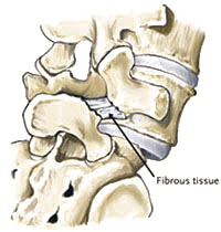 Spondylolisthesis