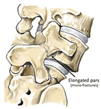 Spondylolisthesis