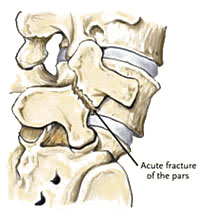 Spondylolisthesis